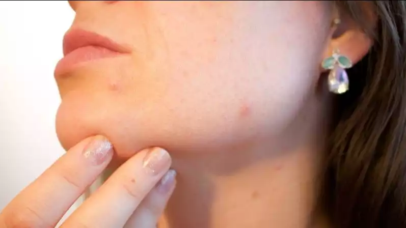 Ilustrasi kulit wajah berjerawat