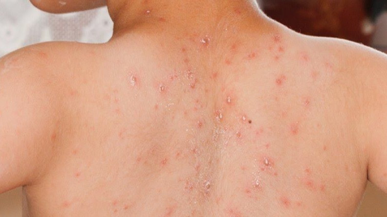 Musim Hujan Rawan Terkena Campak, Kenali Gejala dan Penanganannya pada Anak
            - galeri foto