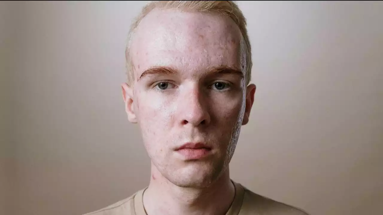 ilustrasi wajah berjerawat