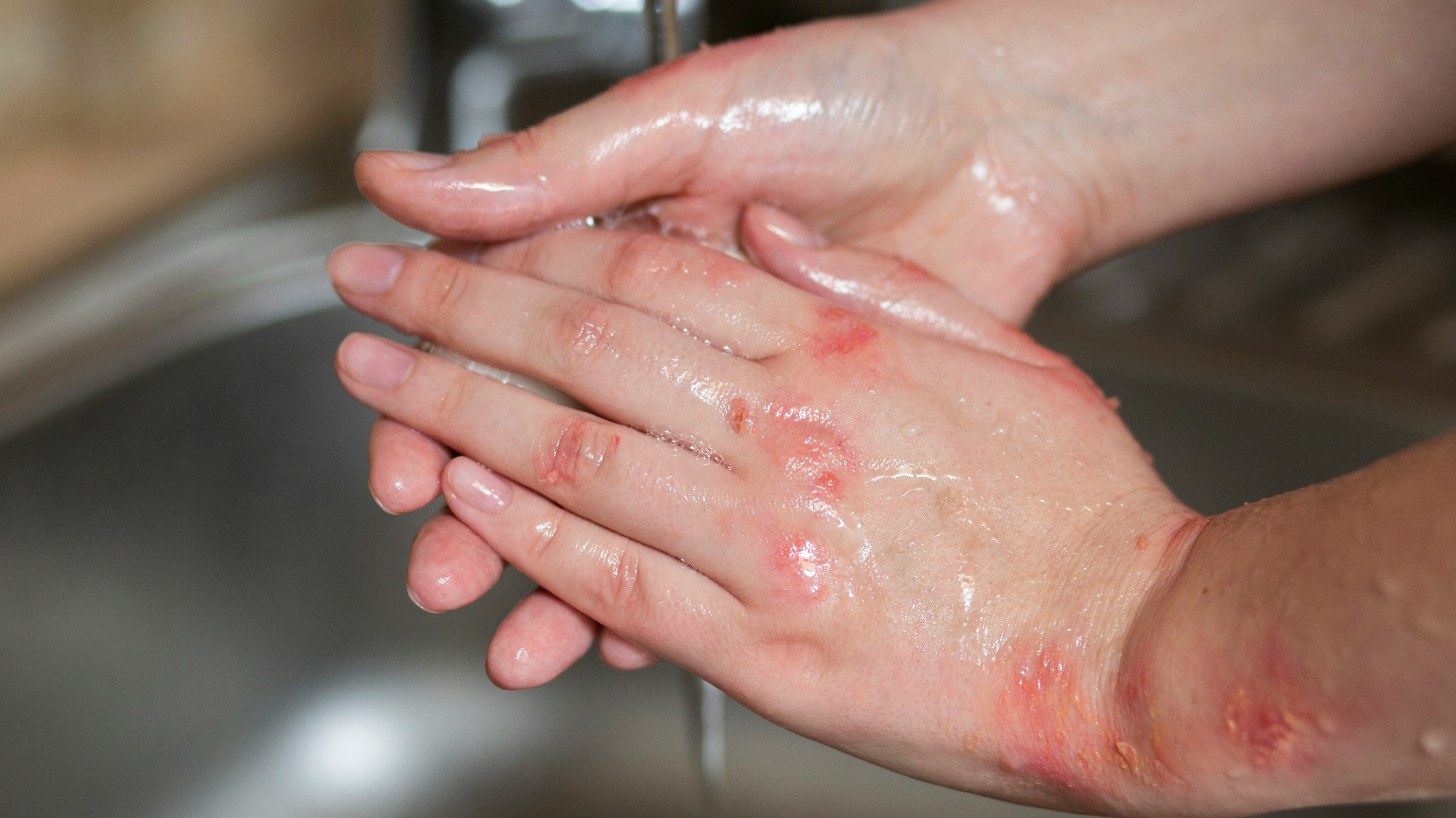 Ilustrasi Luka Bakar