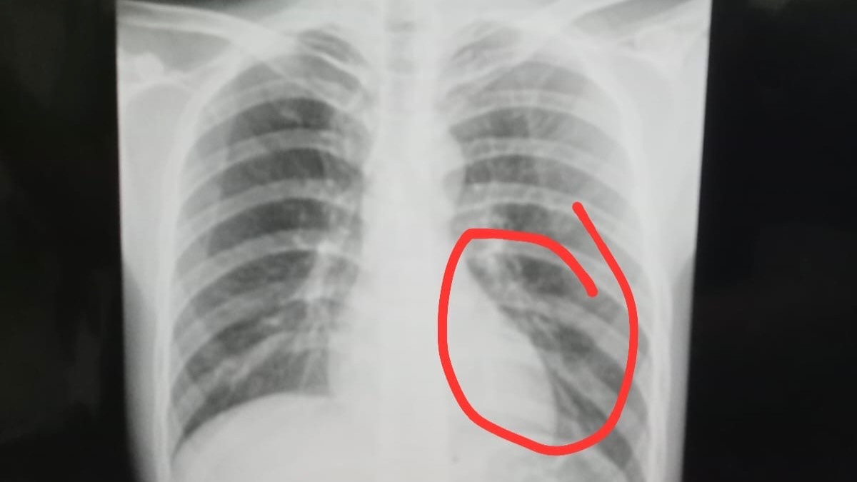 pemain Perseta Tulungagung bernama Firman Nugraha mengalami cedera serius berupa retak tulang dada