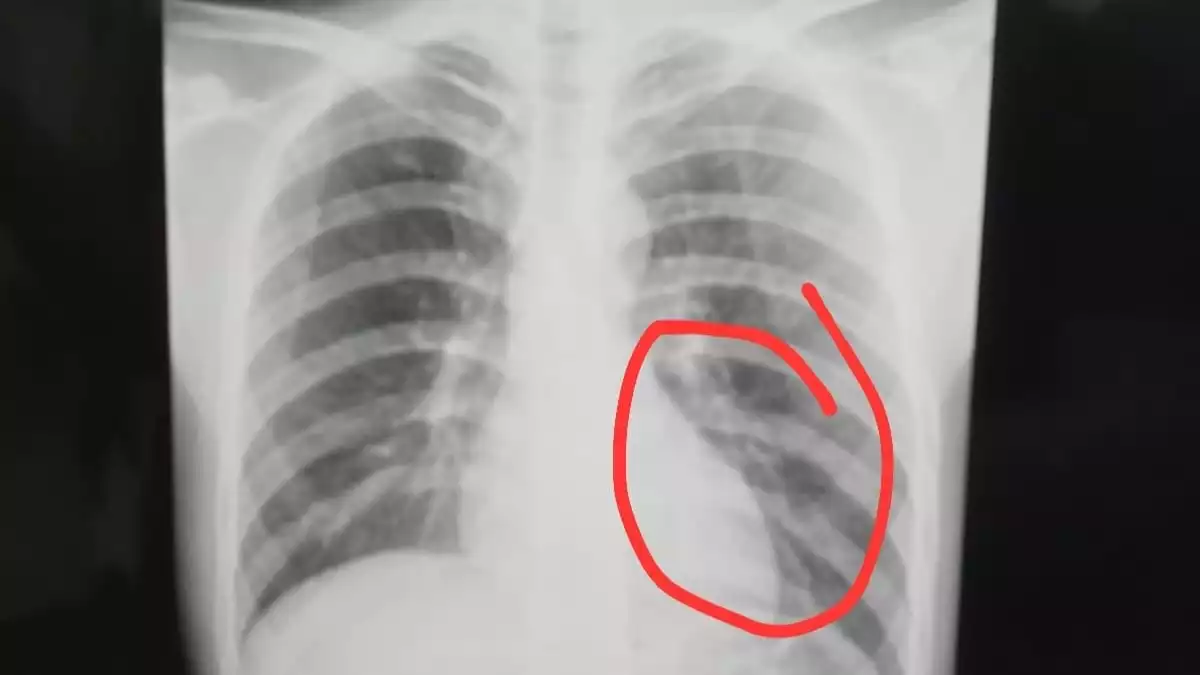 pemain Perseta Tulungagung bernama Firman Nugraha mengalami cedera serius berupa retak tulang dada