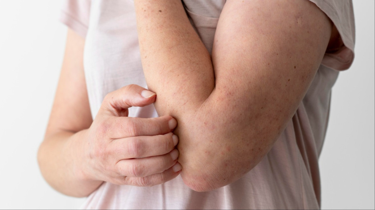 Tips Cepat Atasi Kulit Gatal Setelah Kehujanan
            - galeri foto