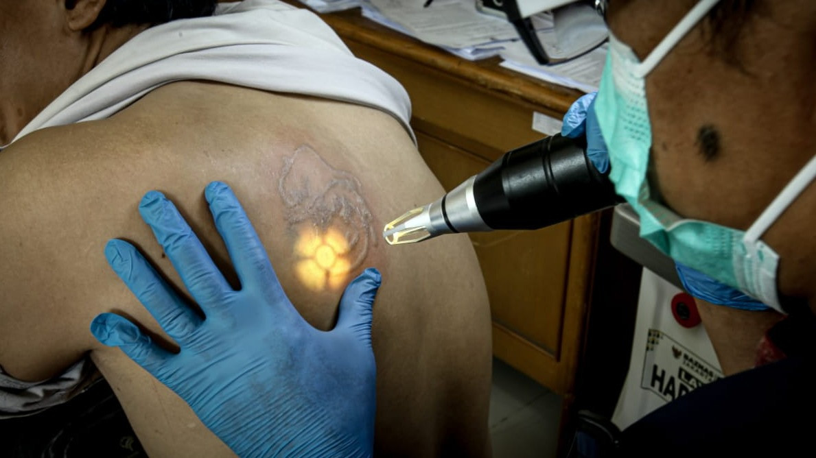 Berita Foto: Antusiasme Warga Padati Program Hapus Tato Gratis
            - galeri foto