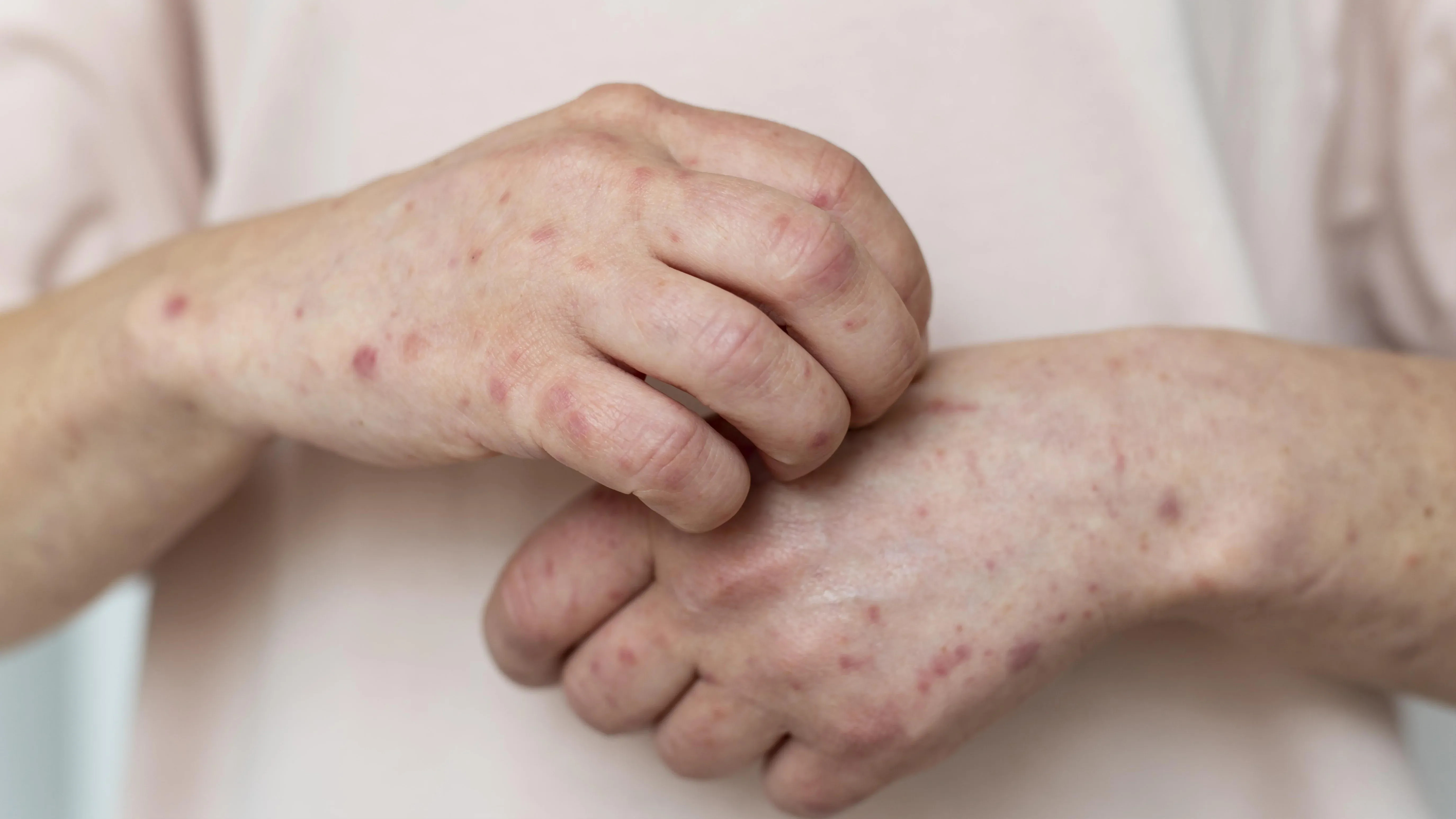 Jangan Remehkan! Satu Dokter Meninggal karena Campak, Masyarakat Diimbau Segera Vaksin