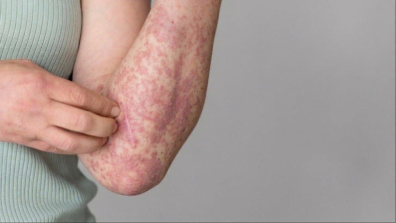 Ternyata Gejala Campak ini yang Dialami Dokter AMW sebelum Meninggal, Jika Anda Mengalami Langsung ke Dokter!