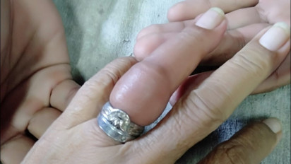 Jangan Pakai Cincin Kekecilan Kalau Tak Mau Jari Bengkak seperti Nenek Ini