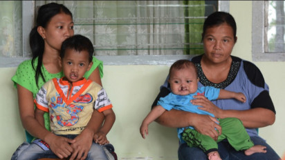 Psikolog: Bibir Sumbing Bukan Aib Keluarga