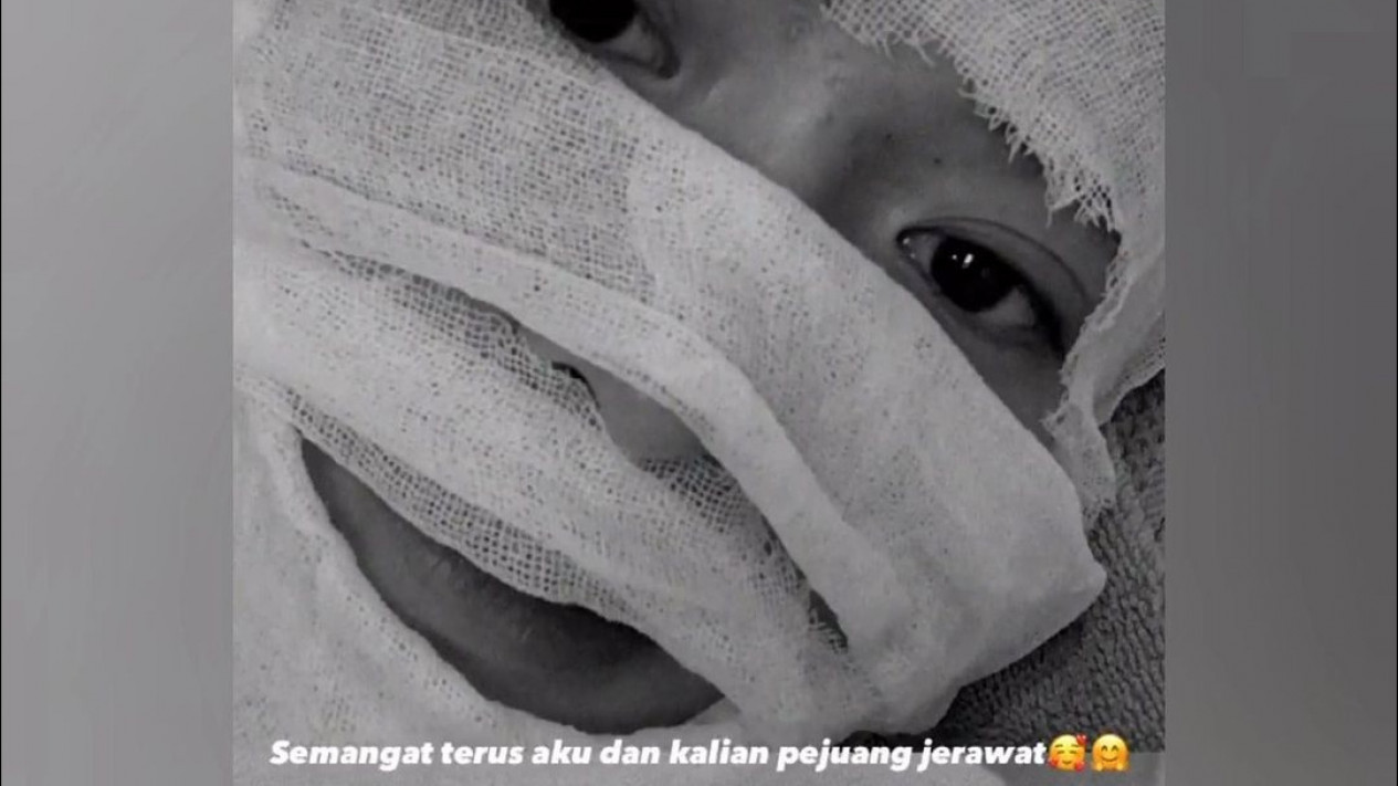 Nissa Sabyan Unggah Wajah Diperban, Netizen: Azab Pelakor
            - galeri foto