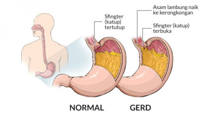 Wajib Tahu! 5 Tips Hindari GERD atau Asam Lambung