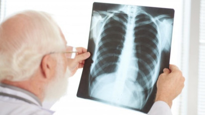 Jadi Komorbid Covid, Ketahui Cara Mencegah Penyakit TBC