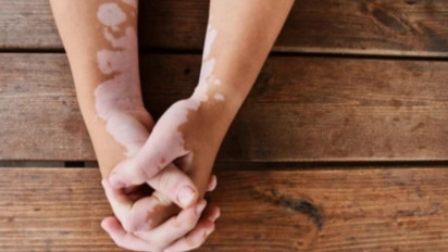 Tetap Bisa Divaksin Covid-19, Ini Seluk Beluk Penyakit Autoimun yang Menyerang Kulit