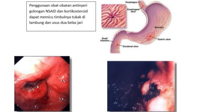 Oma dan Opa Jangan Sembarang Minum Obat Pegal Linu Supaya Terhindar dari Lambung Berlubang, Gagal Ginjal & Jantung