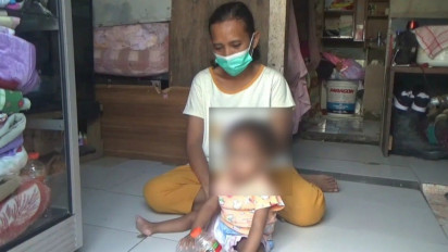 Derita Balita Berkelamin Ganda di Surabaya, Kurang Gizi sehingga Tidak Bisa Dioperasi