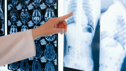 Waspada! Pengaruhi Risiko Kerusakan Paru Pada Pasien PascaCOVID-19