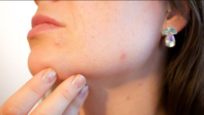 Jerawat Muncul Saat Berpuasa Ramadhan, Apa Sebabnya?
