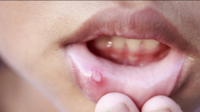 Waspada! Sariawan Gejala Diabetes