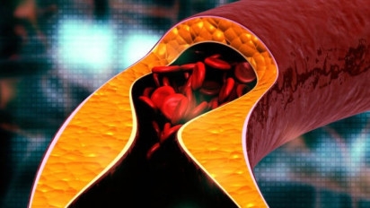 Begini Cara Mudah Turunkan Kolesterol Tinggi Secara Alami Tanpa Obat Kimia