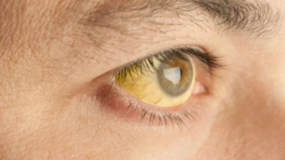 Mengenal Hepatitis berdasarkan Gejalanya