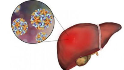 Dugaan Hepatitis Akut di Indonesia Bertambah 14 Kasus