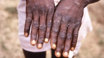 Awas Kena! Begini Cara Penularan Cacar Monyet atau Monkeypox