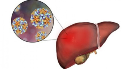 Seorang Anak di Meksiko Meninggal Karena Hepatitis Parah
