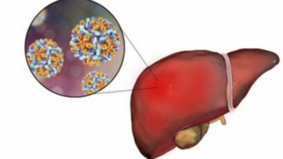 Penyebab Hepatitis Akut Belum Jelas, Kemenkes: Masih Diteliti