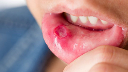 Timbul Sariawan di Bibir? Berikut 5 Cara Mengatasinya, Hindari Lakukan Ini Ya!