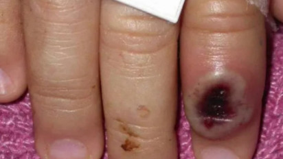 Kemenkes: Cacar Monyet Kategori Zoonosis dan Belum Ditemukan di Indonesia