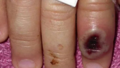 Kemenkes Terbitkan Surat Edaran Himbau Masyarakat Waspadai Cacar Monyet, Begini Gejala-Gejalanya