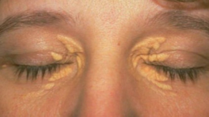 Mengenal Xanthelasma, Gejala Kolesterol Tinggi yang Muncul di Sekitar Mata