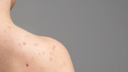 Bisa dengan Pakai Bahan Alami hingga Rajin Lakukan Hal Ini, Berikut Tips Mengatasi Jerawat Punggung