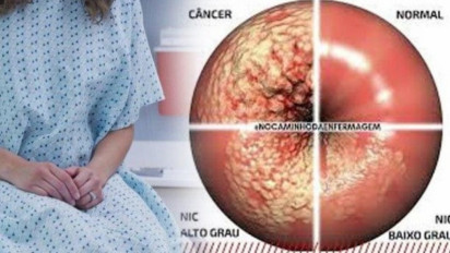 Penting untuk Wanita, Kanker Serviks Stadium Awal Tak Ada Gejalanya Sama Sekali, Berbahaya dan Mematikan