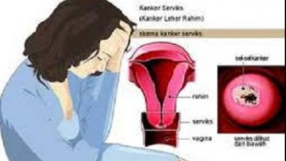 Hat-hati ya Wanita, Kanker Serviks Stadium Awal Tak Ada Gejalanya Sama Sekali, Baca Ini!