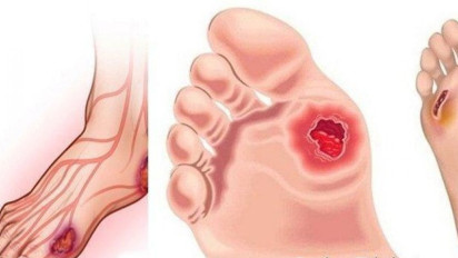 Cara Mudah Menurunkan Gula Darah Tinggi Tanpa Obat-obatan Kimia, Jangan Sampai Anda Kena Diabetes