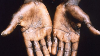 Afrika Selatan Laporkan Kasus Pertama Cacar Monyet