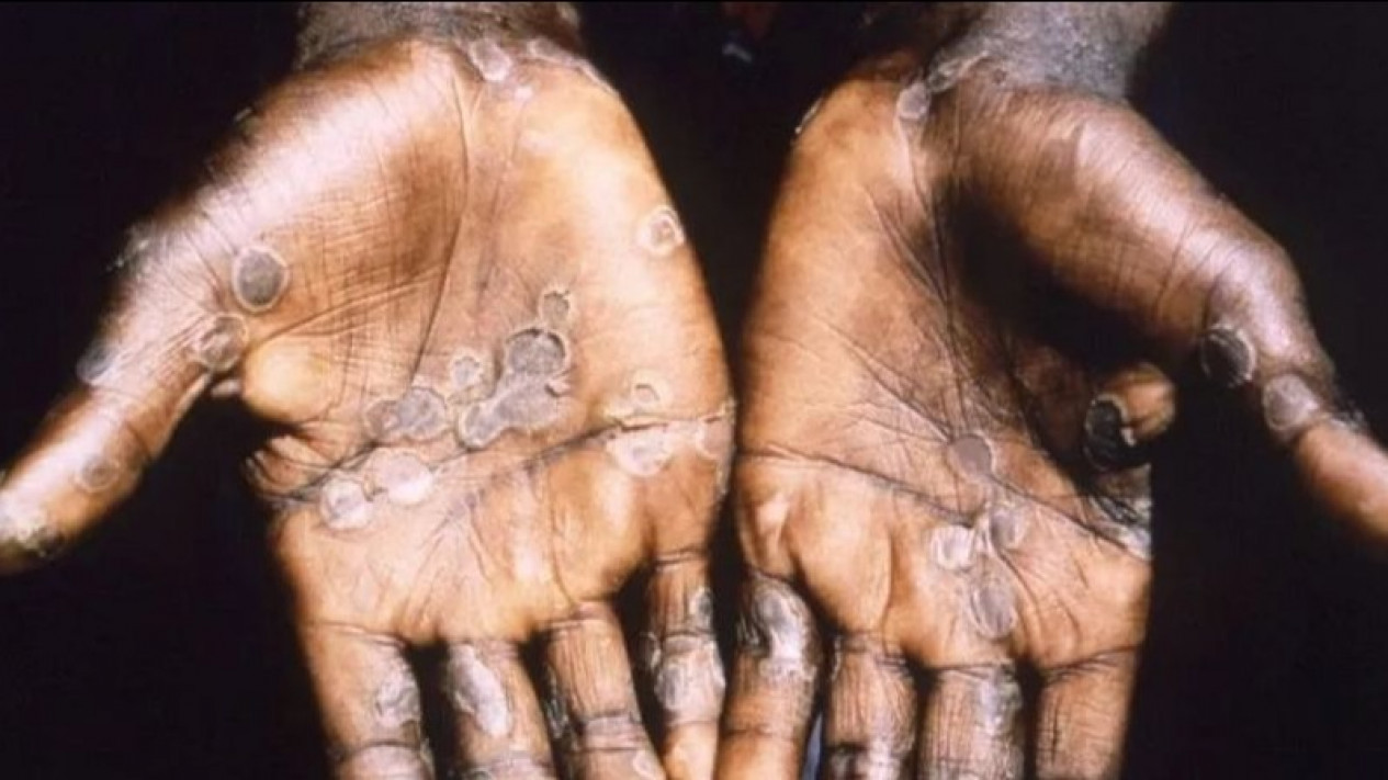 Cacar Monyet Jadi Darurat Kesehatan Global, Bakal Ada Vaksinasi Lagi?
            - galeri foto