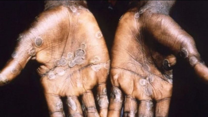 Cacar Monyet Jadi Darurat Kesehatan Global, Bakal Ada Vaksinasi Lagi?