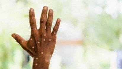 Waspada! WHO Pantau Cacar Monyet Menyebar Cepat ke Banyak Negara