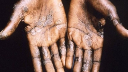 Ditemukan di Singapura, IDI Minta Semua Dokter Waspadai Gejala Cacar Monyet pada Pasien yang Ada di Indonesia    