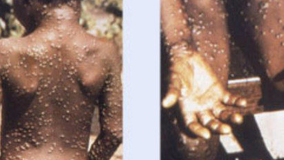 Penyakit Cacar Monyet (Monkeypox), Penyebab, Gejala, dan Cara Mencegahnya