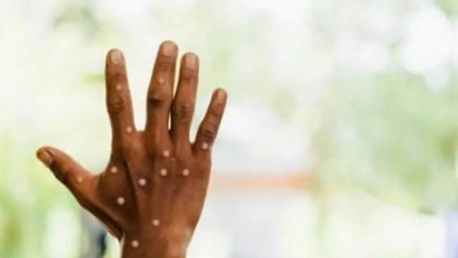 Ini Perbedaan Cacar Monyet dengan Cacar Air