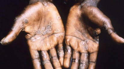 Dinkes DKI Jakarta Pastikan Pasien Cacar Monyet Membaik, Tapi Masih dalam Pantauan 