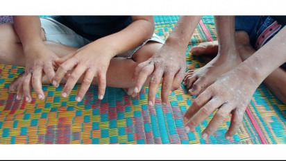 Ratusan Warga Madina Diserang Penyakit Gatal-gatal Mirip Cacar Monyet