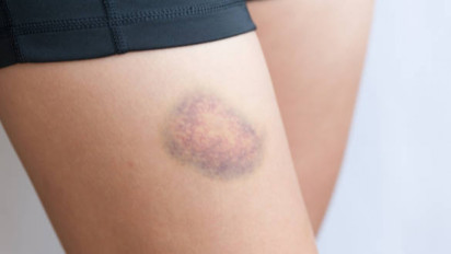 Memar Di Tubuh Tanpa Sebab, Hati-Hati Tanda Diabetes Karena Gula Darah Tinggi