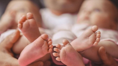 Bayi Kembar Siam Dua Kepala Satu Badan Dirujuk ke RSUP dr M Djamil Padang 