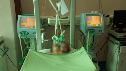 Kondisi Bayi Kembar Siam Berkepala Dua di Padang Masih Kritis