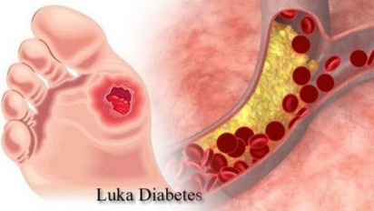 Duh, Jangan Sampai deh Kena Diabetes, Nih Cara Mudah Turunkan Kadar Gula Tinggi Tanpa Menggunakan Obat-obatan Kimia