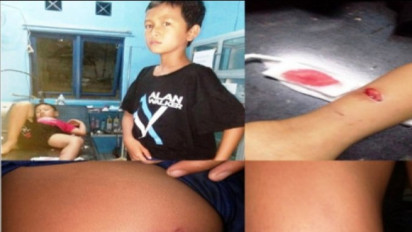 Seorang Anak Perempuan Alami Luka Gigitan Akibat Terkena Gigitan Anjing Tetangga yang Tidak Diikat di Tangerang