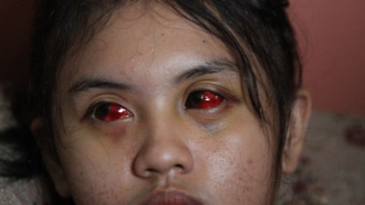 Polri Pastikan Korban Tragedi Kanjuruhan dapat Perawatan hingga Pulih Termasuk Trauma Healing